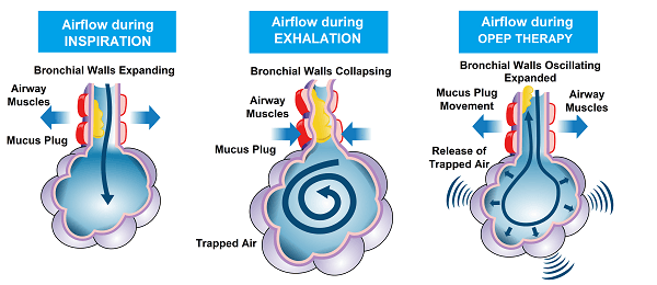 Air-Trapping-and-OPEP-Therapy-600